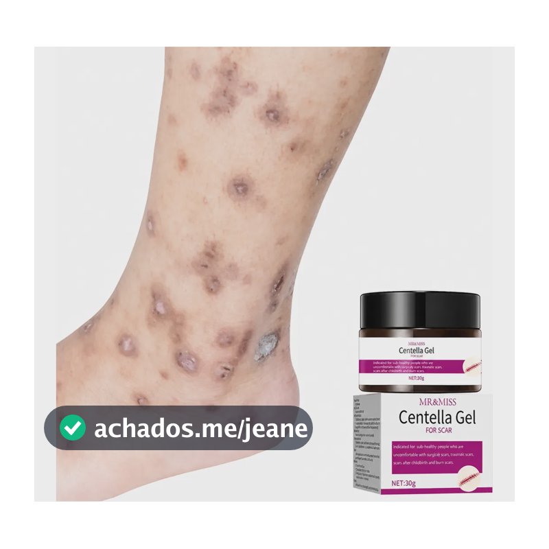 Creme Para Cicatriz Creme Removedor De Cicatrizes Estrias Lavanda